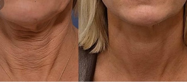 Laser Skin Tightening