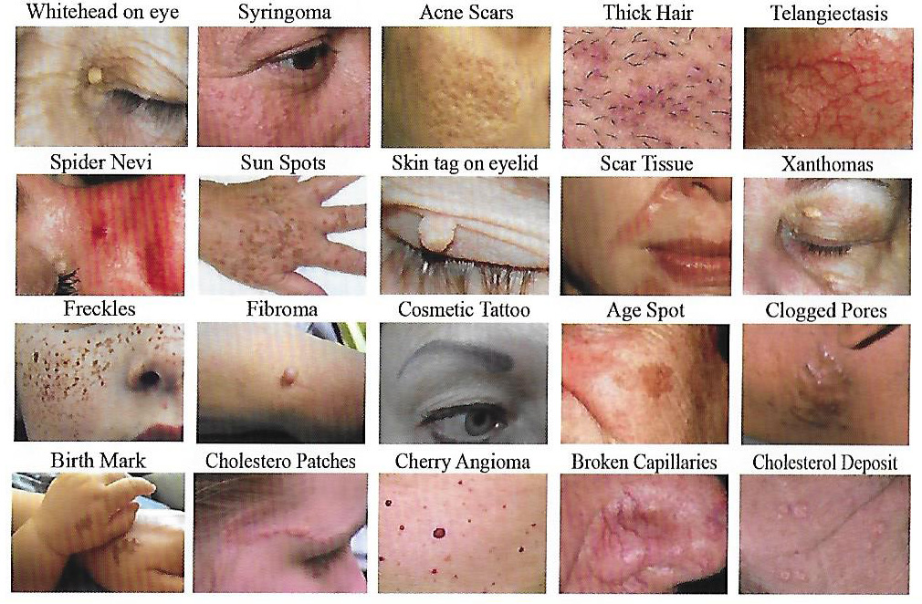 Skin Irregularity