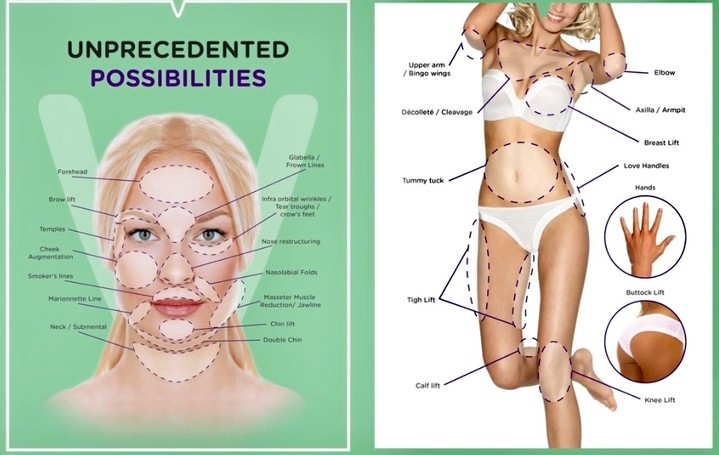 Facelift